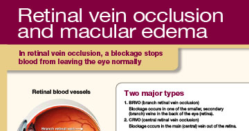 rvo patient education sheet