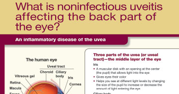 uveitis patient education sheet