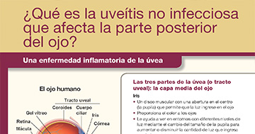 uveitis patient education sheet